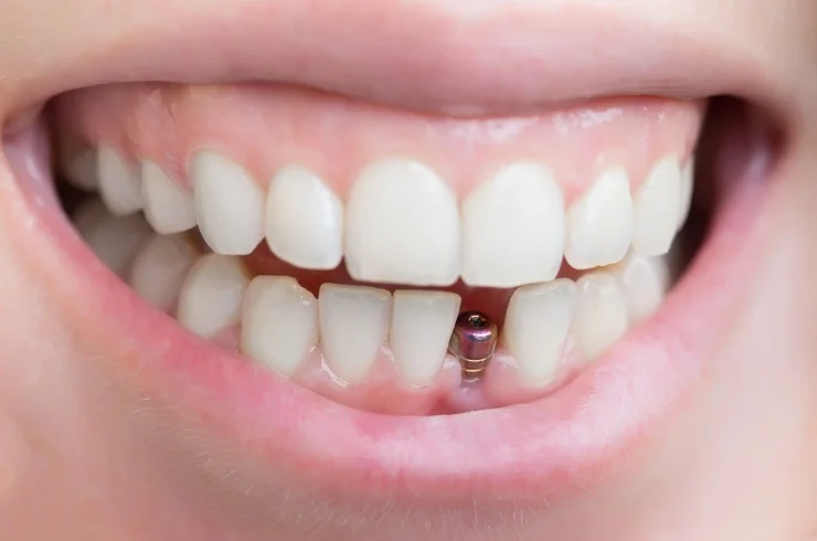 Dental Implants--------14