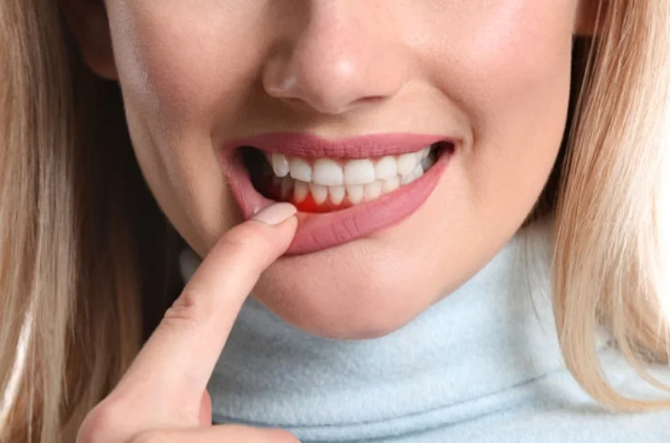 Gum Treatment------14
