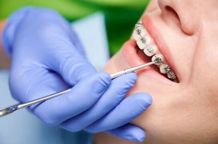 Orthodontic Treatment----------14