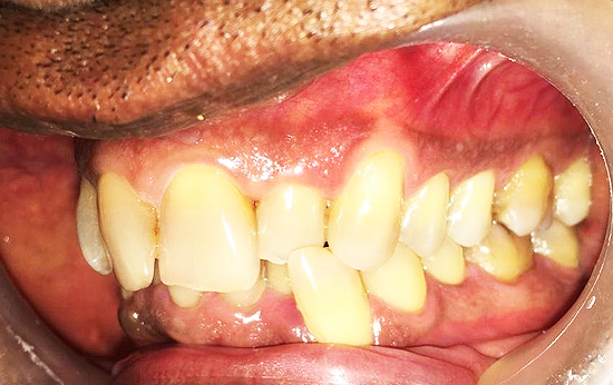 Crossbite