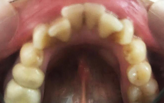 Over Crowded teeth