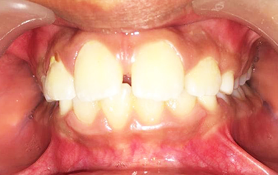 Widely spaced teeth